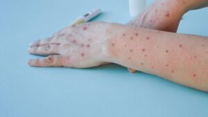 Confirma Secretaría de Salud un nuevo caso de viruela del mono en Jalisco - ZMG Noticias