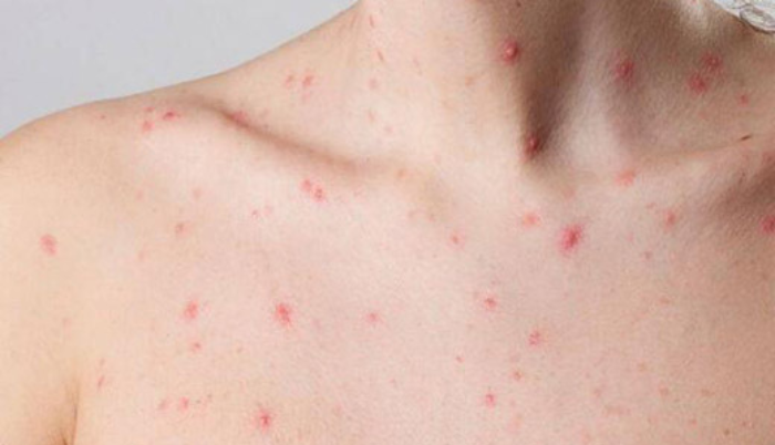 Notifican a Jalisco seis nuevos casos de viruela símica - ZMG Noticias