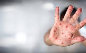 Ya van 192 casos confirmados de viruela símica en Jalisco - ZMG Noticias