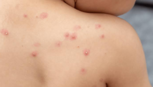 Mujeres con viruela símica sin relación entre sí