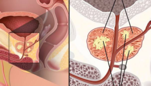 Advierten sobre casos de cáncer de próstata