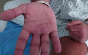 Viruela del Mono: Jalisco, una de las 3 entidades que realizan sus propias pruebas de detección