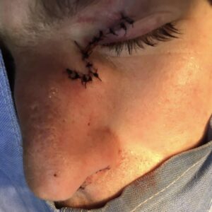 Sufre tremenda cornada en el ojo el torero “El Payo” - ZMG Noticias Sufre tremenda cornada en el ojo el torero “El Payo” - ZMG Noticias