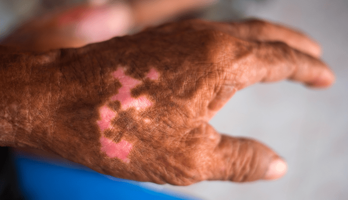 Ssa pone en vigilancia 12 municipios por casos de lepra