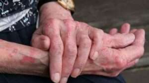 Asegura Salud Jalisco que es falso el aumento de lepra en 3 municipios - ZMG Noticias