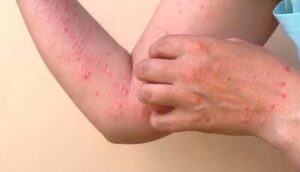 Salud Jalisco intensifica vigilancia por viruela de mono - ZMG Noticias