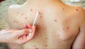 Descartan casos de sarampión en Jalisco - ZMG Noticias