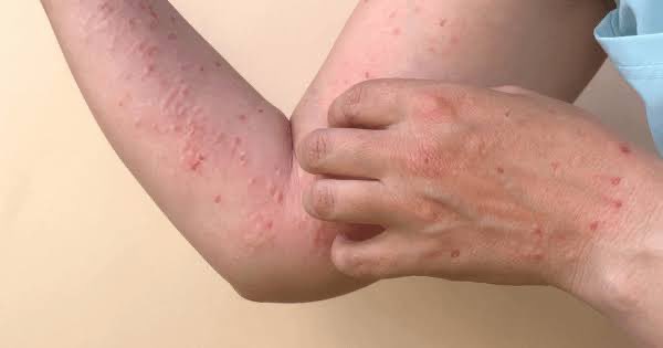 Confirman primera muerte por Mpox en Jalisco - ZMG Noticias