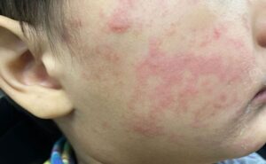 Suspenden clases en escuela de Tlaquepaque por brote de sarampión - ZMG Noticias