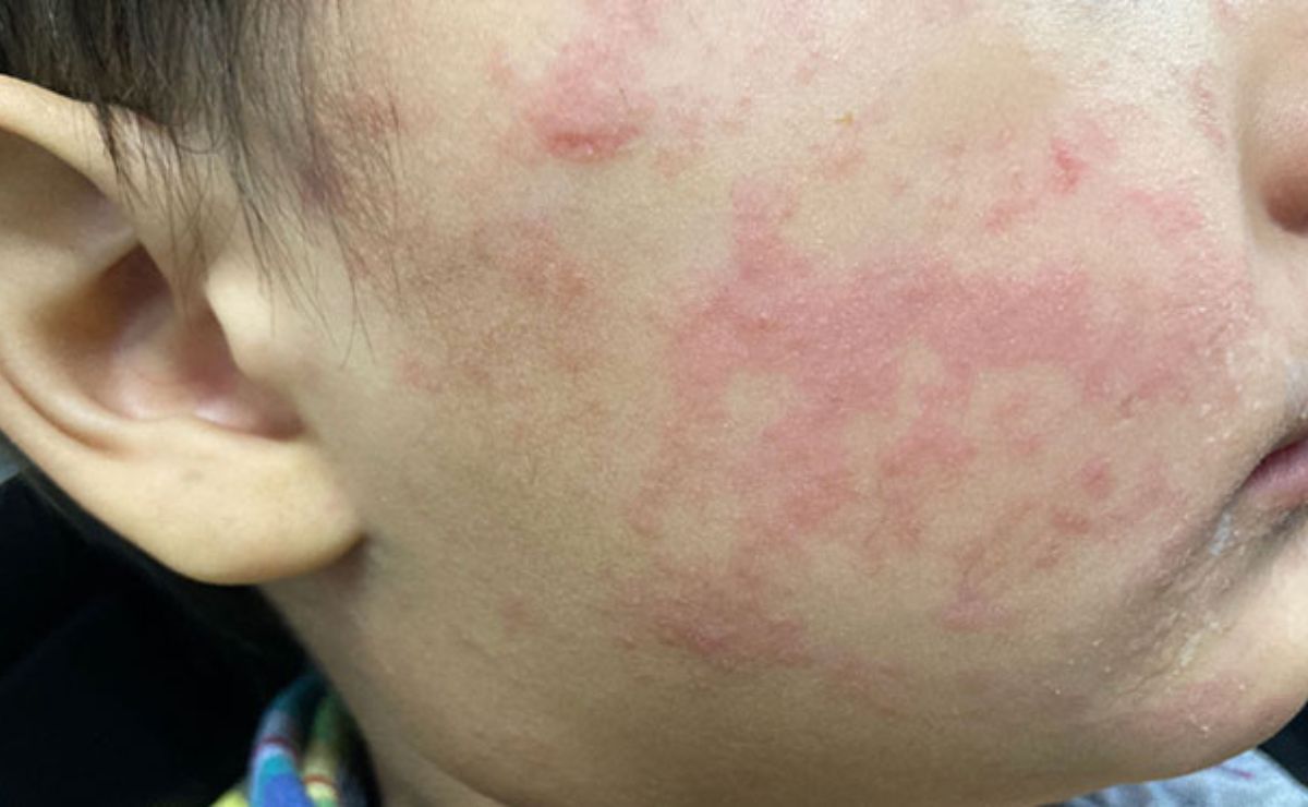 Suspenden clases en escuela de Tlaquepaque por brote de sarampión - ZMG Noticias