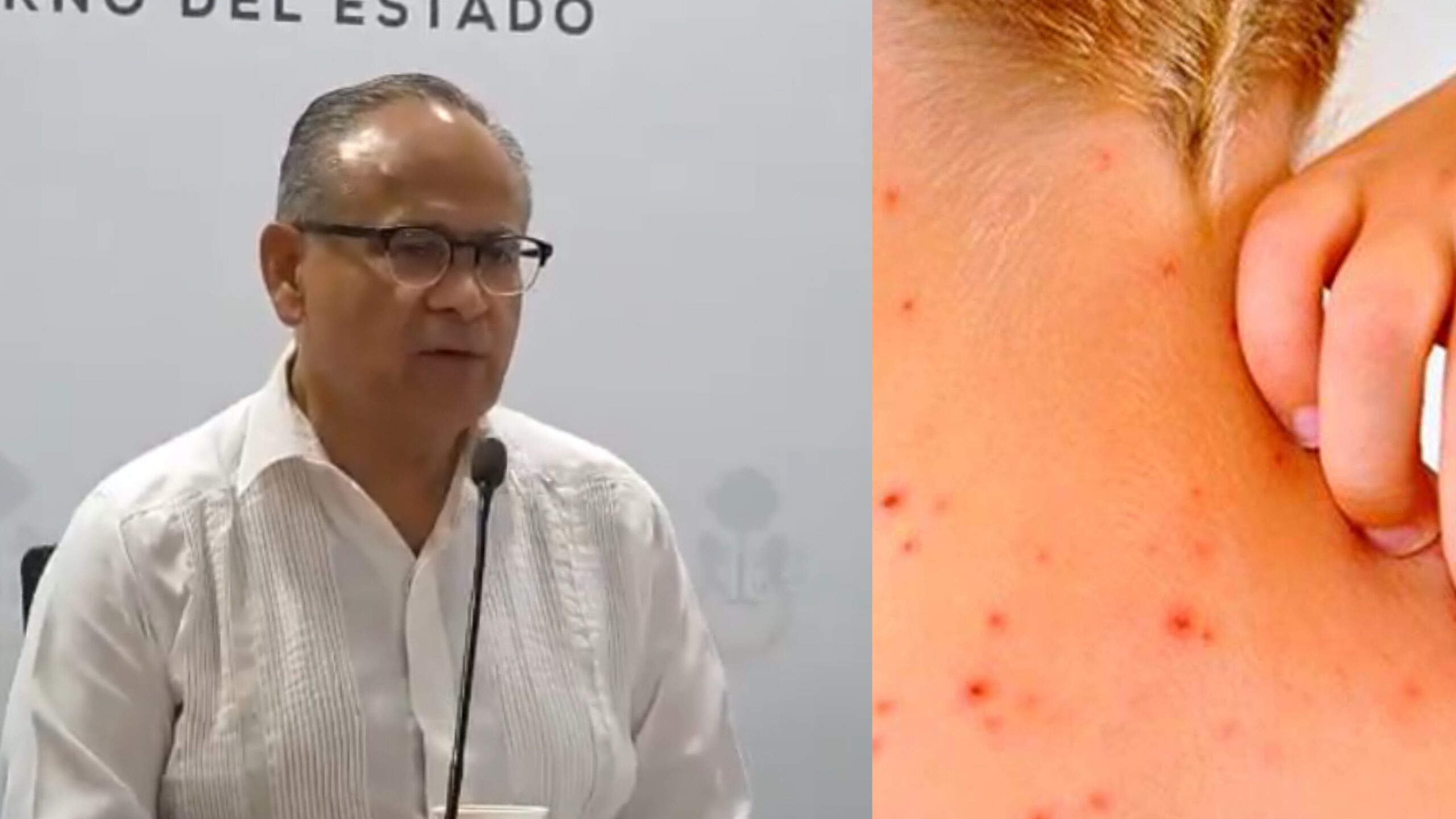 Jalisco en alerta por casos de sarampión - ZMG Noticias