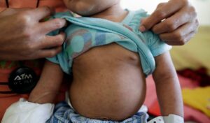 Muere bebé de un año por sarampión